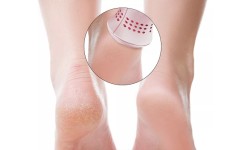 Foot Hard Skin Removers and Devices