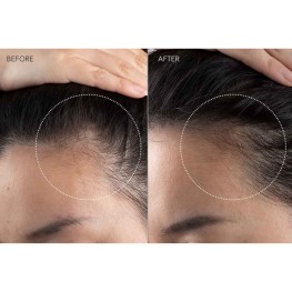 Light Therapy For Hair Growth and  T-SonicTM Massage